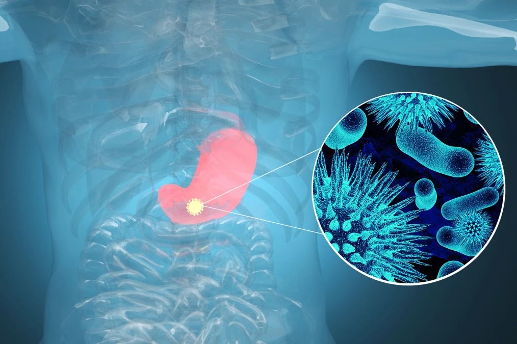 肿瘤标记物CA72-4：“胃”，你还好吗？